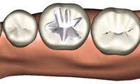 従来の銀歯による治療
